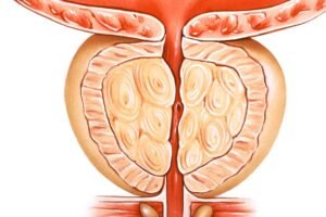 Can BPH Be Cured Naturally Explained