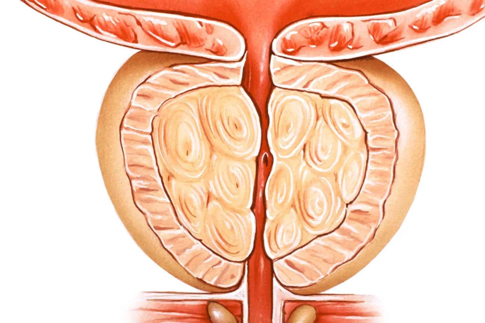 Can BPH Be Cured Naturally Explained